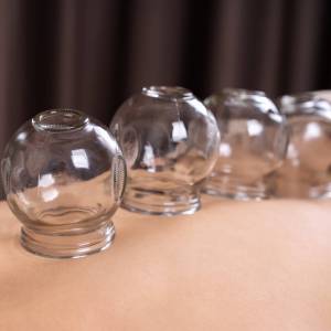 young woman receiving cupping treatment on back